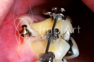 mini implante ortodontico4
