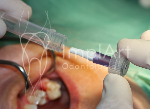 implante_zirconia