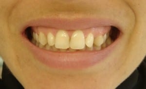 agenesia dental