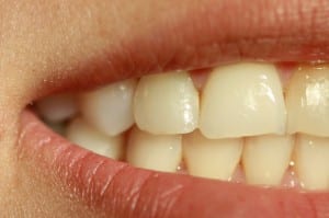 agenesia_dental