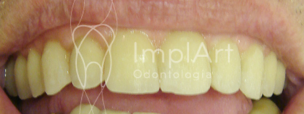 implante_dental_total