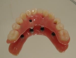 implante_dentario