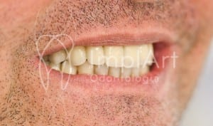 implante_dentario_carga_imediata