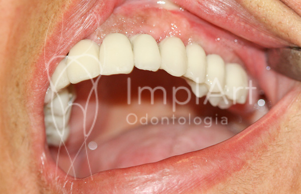 implante_dentario_fixo implante_dentario_fixo