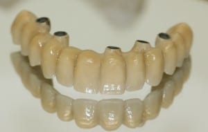 implante_total_dentes