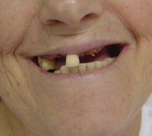 implantes_dentarios1