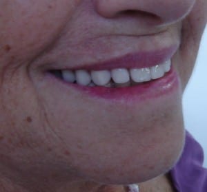 implantes_dentarios2_1