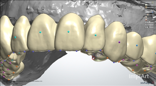 implart_implante_dentario_cad_cam