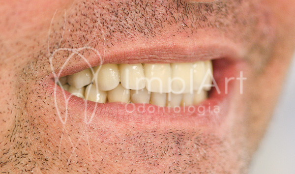 carga_imediata_implante_dentario_porcelana