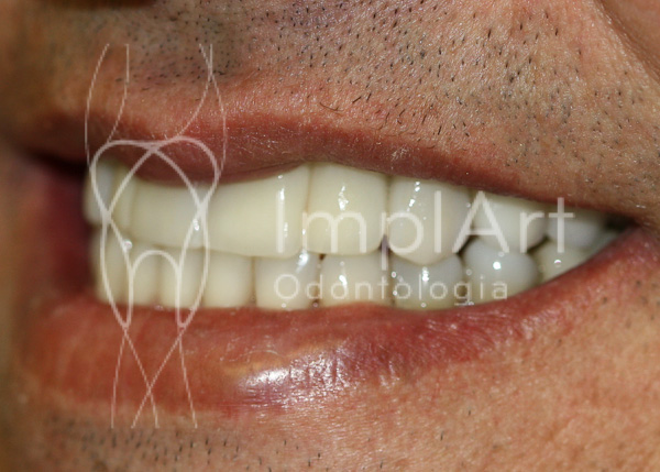implante_dentario_total_zirconia