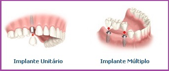 implantes_tipos