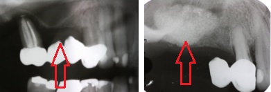 Exames radiológicos: a primeira imagem mostra o defeito decorrente da perda Óssea. A segunda imagem mostra a formação óssea dois meses depois do enxerto. 
