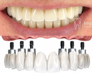 all-on-6-37ed15c0 Clínica de Implante Dentário e Prótese Dentária ImplArt