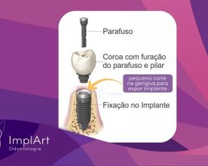 reabertura-de-implante-720-x-480-px-2-900ae22b Clínica de Implante Dentário e Prótese Dentária ImplArt